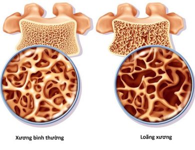 BỆNH LOÃNG XƯƠNG Ở PHỤ NỮ MÃN KINH